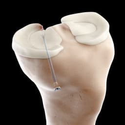 WasherCap™ Mini - Meniscal Root