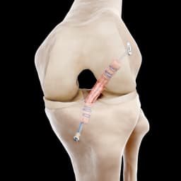 WasherCap™ Mini - ACL