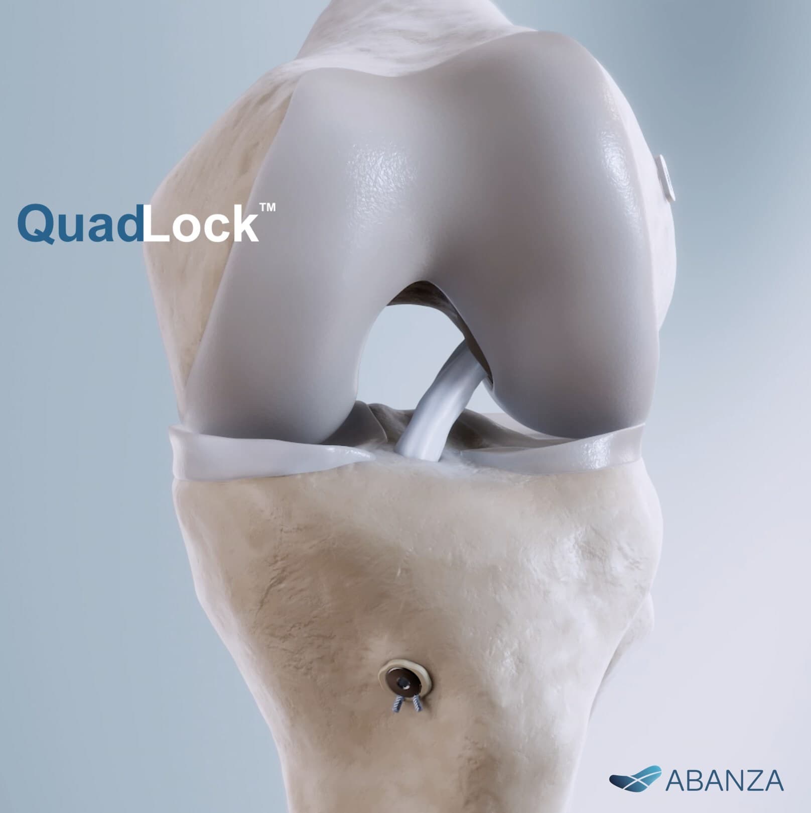 ABANZA Secures FDA 510(k) Clearance for QuadLock™ Fixation System for ACL Reconstruction