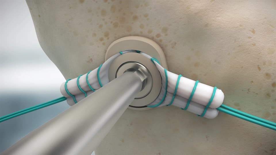 The Rehab Journey Shouldn’t Undo What Was Perfected in the OR